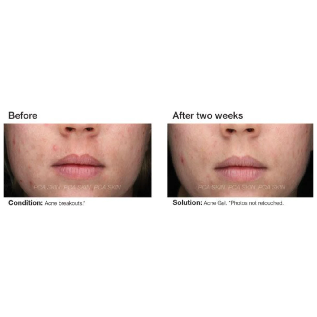 Acne Gel - Pilt 3