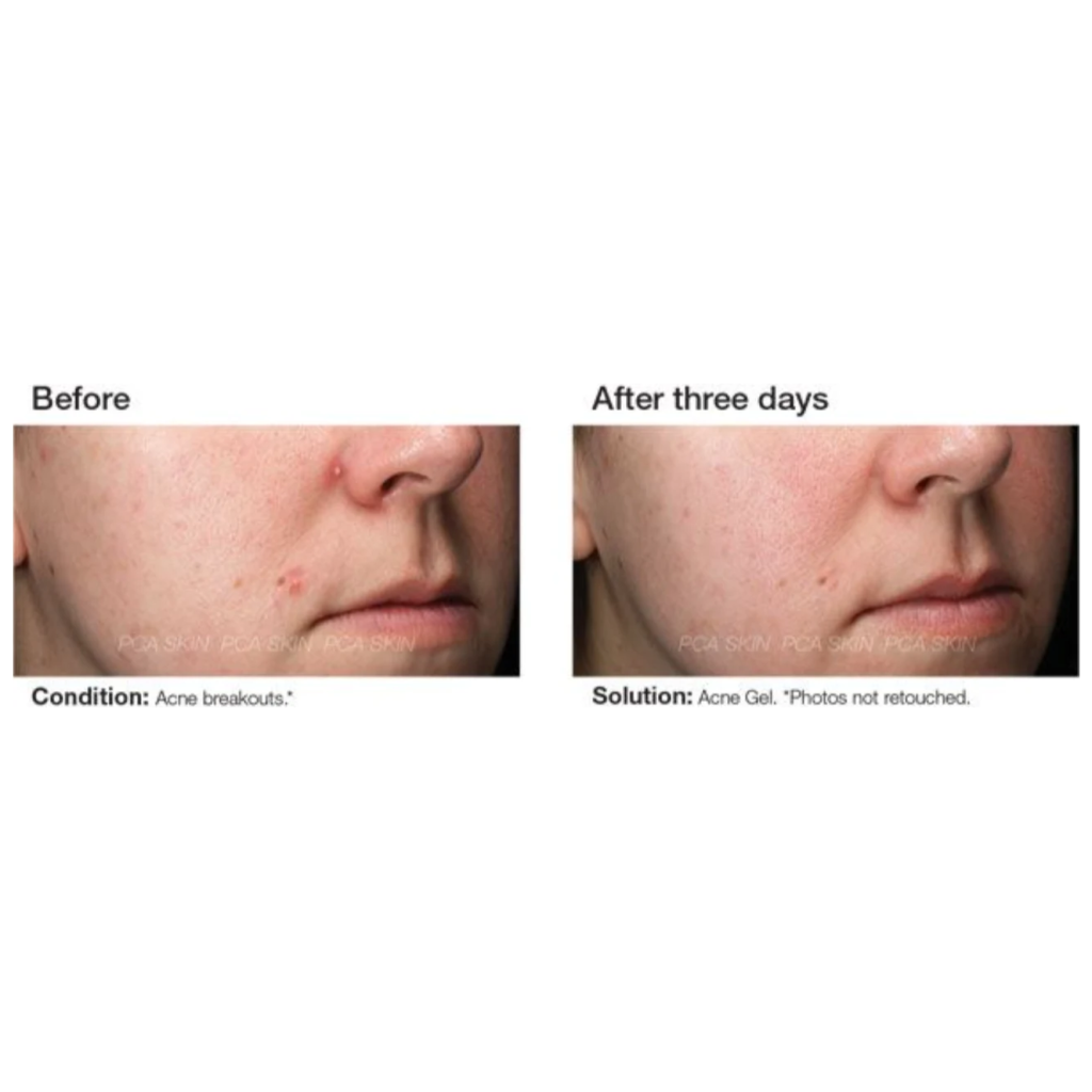 Acne Gel - Pilt 4