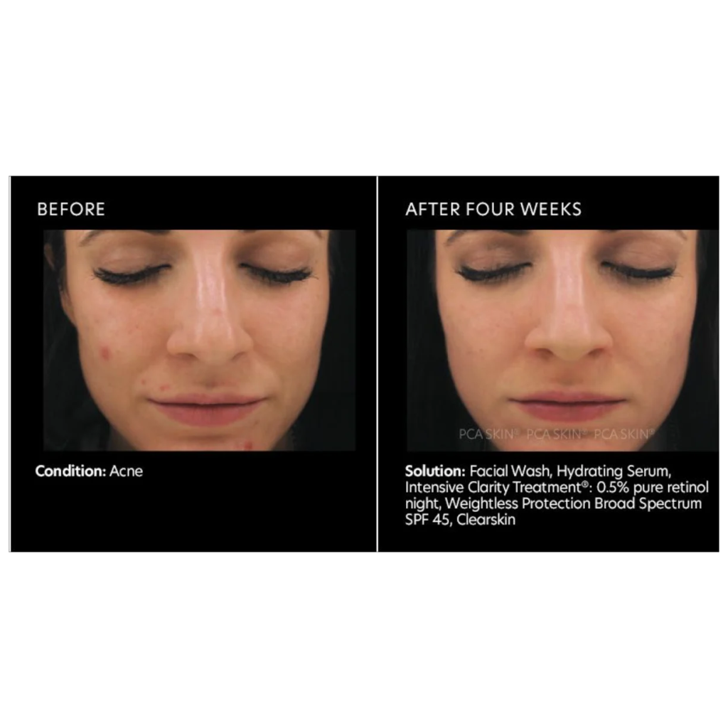 Intensive Clarity Treatment - Pilt 4